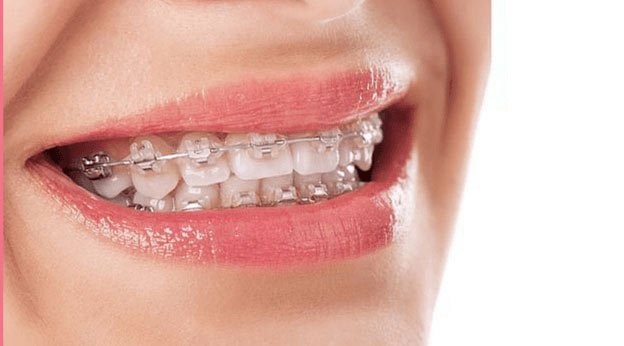 ankara_ortodonti_poliklinigi_after