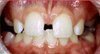 diastema_ankara_ortodonti